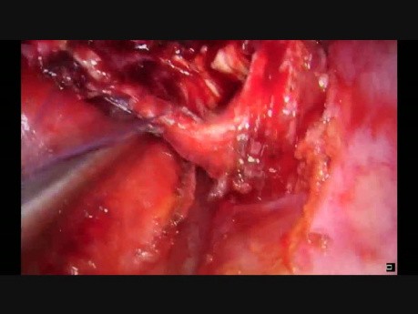 Uniportal Thoracoscopic Sleeve Lobectomy after Induction Therapy