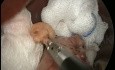 3 Keyholes Posterior Cruroraphy with Sleeve Gastrectomy