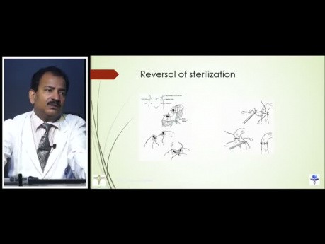 Laparoscopic Sterilization