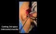 Internal Mammary Lymph Node Dissection