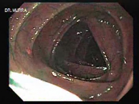 Narrow Band Imaging (NBI) (1 of 3)