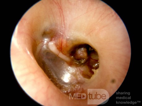 Cholesterol Granuloma Middle Ear