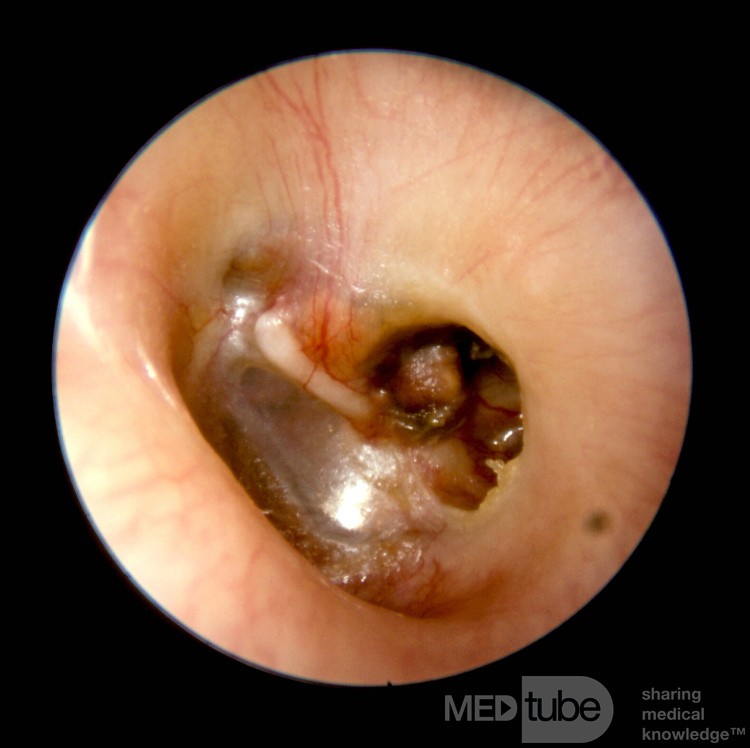 Cholesterol Granuloma Middle Ear