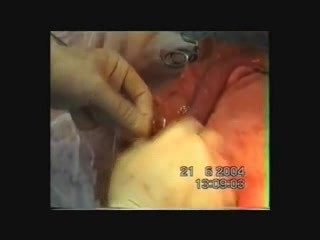 Esophagogastrectomy - Esophageal Cancer Surgery
