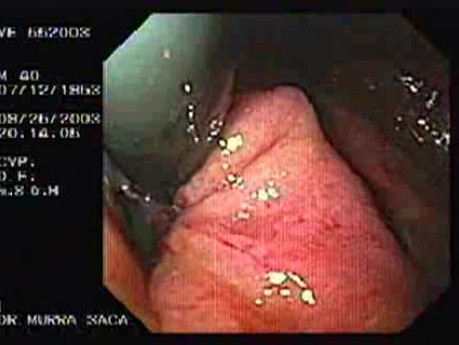 Acute Variceal Bleeding - Violet Varix with Necrotic Changes