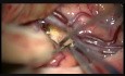 Broad-Neck Giant Intracranial rtMCA Aneurysm