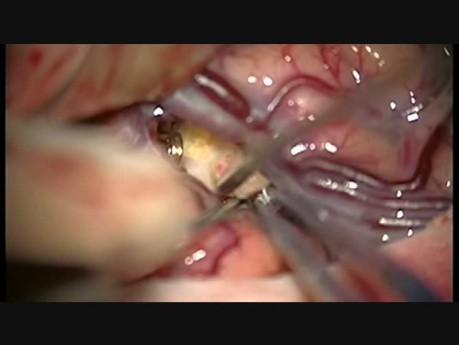 Broad-Neck Giant Intracranial rtMCA Aneurysm