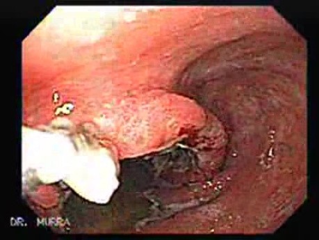 Adenocarcinoma of the Corpus and Antrum (5 of 5)