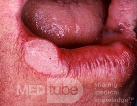 Squamous Cell Carcinoma of the Lip