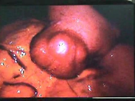 Jejunal Gastrointestinal Stromal tumor (GIST) (22 of 86)