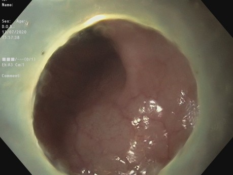 Endoscopic Submucosal Dissection in a Rectal Lateral Spreading Tumor