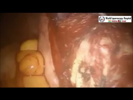 Robotic Myomectomy