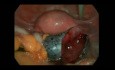 Laparoscopic Cystectomy With Adnexal Torsion