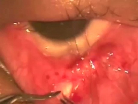 LPS plication of Marcus Gunn ptosis