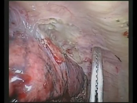 VATS Lobectomy Lower Lobe-Chest Wall Resection