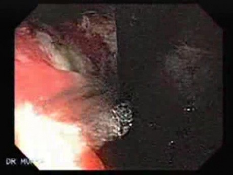 Synchronous Cancer (Gastric and Esophageal) - Endoscopic Visualization of Neoplastic Changes