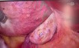vNOTES Myomectomy