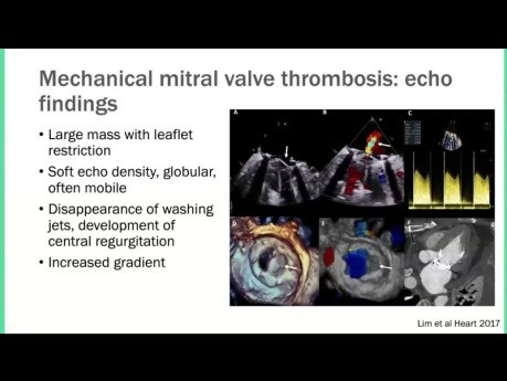 Echocardiographic Evaluation of Prosthetic Mitral Valves