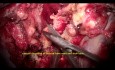 Large Trigeminal Schwannoma Ophthalmic Division Microsurgery