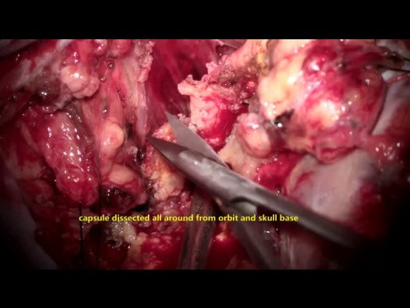 Large Trigeminal Schwannoma Ophthalmic Division Microsurgery