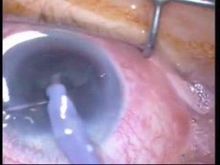 Phacoemulsification - Ozil IP Technique