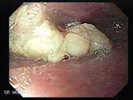Esophageal Squamous Cell Carcinoma of the the upper third of the Esophagus that invades the subglotic (1 of 8)