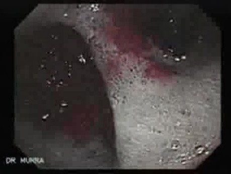 Scirrhous Gastric Carcinoma - Endoscopy (14 of 47)