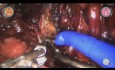Robotic (Versius) Distal Ureterectomy and Ureterovesical Anastomosis