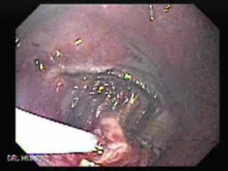 Gastrointestinal Stromal Tumor - GIST (8 of 65)