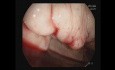Rebleed Fundal Varix - Cyanoacrylate + AB-Gel Injection