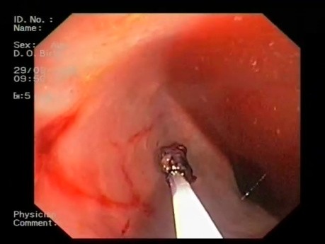 Endoscopic Approach To Bleeding From Rectum After A Prostatic Needle Biopsy