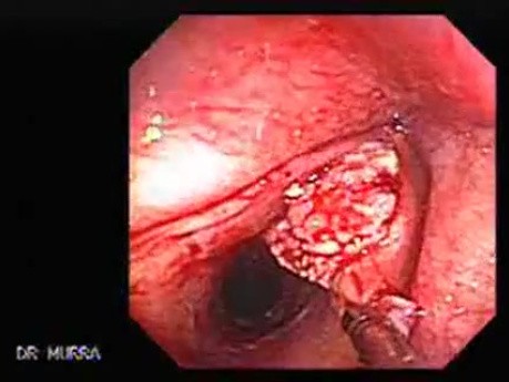 Squamous cell carcinoma of the larynx (3 of 3)