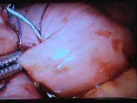 Jejunal Gastrointestinal Stromal tumor (GIST) (73 of 86)
