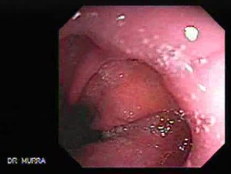 Barrett's Esophagus of long segment - hiatus hernia (16 of 24)