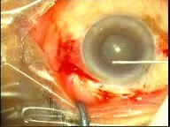 Phacoemulsification - SICS