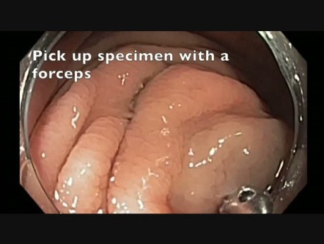 Appendix - Flat lesion - EMR