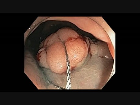 Colonoscopy - Rectum - Laterally Spreading Granular Tumor - EMR Part I