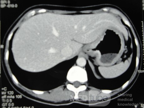 Endoscopy of Scirrhous Gastric Carcinoma involving the entire Fundus, Body and the Antrum (21 of 47)