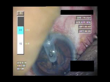 Cataract Surgery XI - Part 2