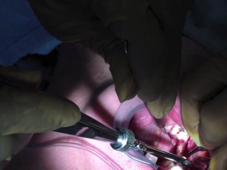 Bone Graft - Ramus Incisions