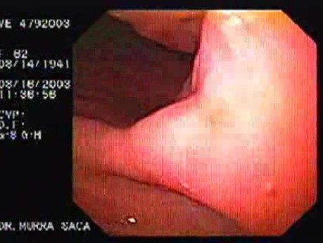 Intraluminal Endoscopic Suturing - Assessment of the Mucosa
