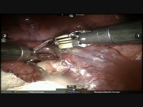Robotic Right Lower Lobectomy