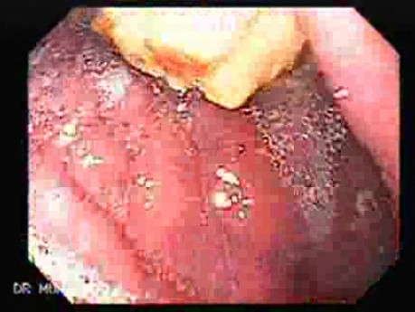 Gastric Lymphoma with Metastases to the Duodenum - Presence of the Food Residuals, Part 1