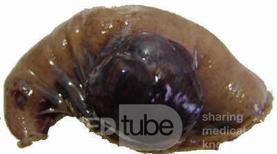 Jejunal Gastrointestinal Stromal tumor (GIST) (6 of 86)