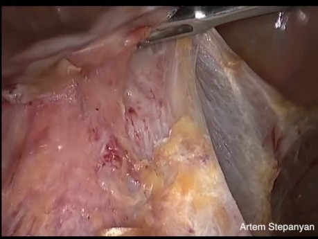 Total Laparoscopic Hysterectomy
