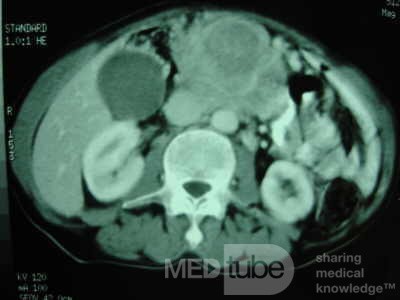 Gastric Ulcer with Gastrocolic fistula due to a Zollinger-
 Ellison Syndrome (28 of 33)