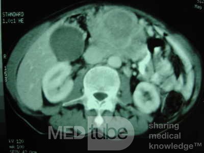 Gastric Ulcer with Gastrocolic fistula due to a Zollinger-
 Ellison Syndrome (28 of 33)