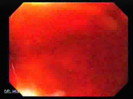 Chromoendoscopy of Barrett's Esophagus