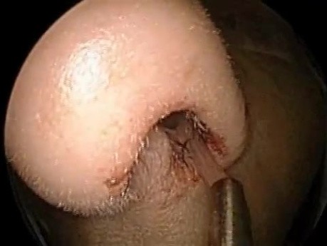 Endoscopic Sinus Surgery - Frontal Polypectomy