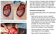 TachoSil® Clinical Cases Gynecological Surgery